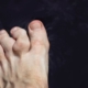 Non-surgical methods for treating hammer toes